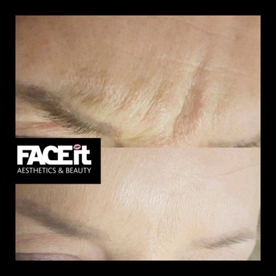 Belle Vie Home of Aesthetics Chesterfield Botox Anti Ageing Image 003