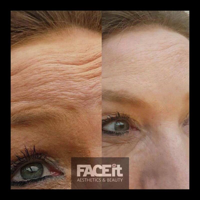 Belle Vie Home of Aesthetics Chesterfield Botox Anti Ageing Image 006
