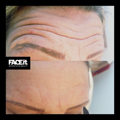 Belle Vie Home of Aesthetics Chesterfield Botox Anti Ageing Image 009