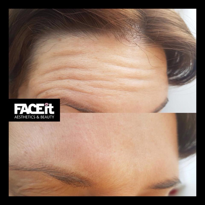 Belle Vie Home of Aesthetics Chesterfield Botox Anti Ageing Image 011