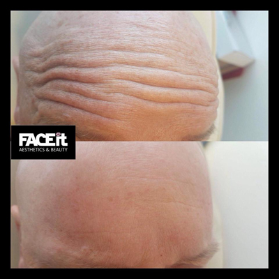 Belle Vie Home of Aesthetics Chesterfield Botox Anti Ageing Image 012
