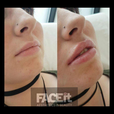 Belle Vie Home of Aesthetics Chesterfield Dermal Lip Filler Image 006