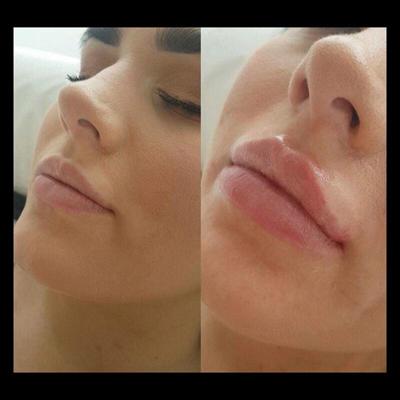 Belle Vie Home of Aesthetics Chesterfield Dermal Lip Filler Image 012